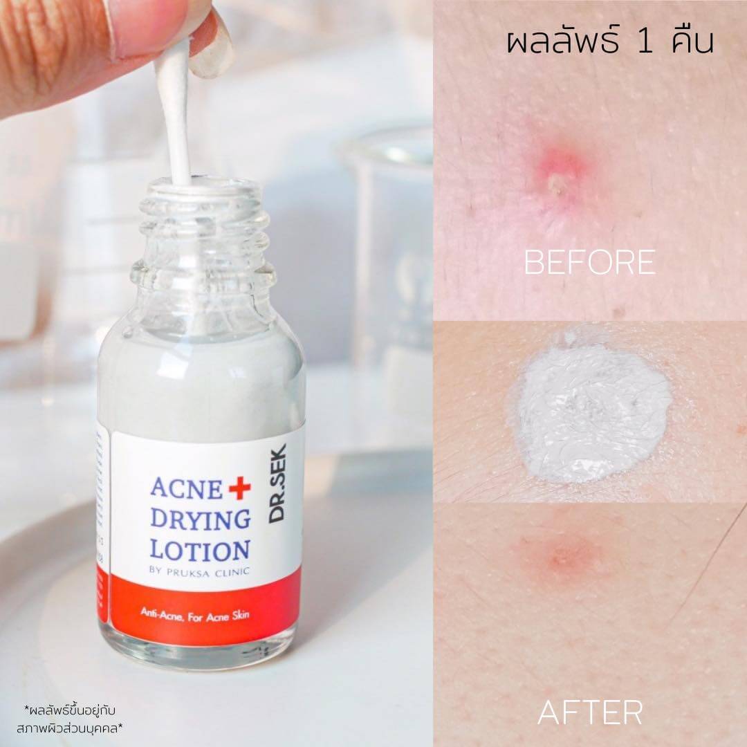 Dr.Sek Acne+ Drying Lotion โลชั่นแต้มสิวโดยคุณหมอ ดูดซับสิิ่งสกปรก ไขมันในรูขุมขน ให้สิวยุบแห้งไว